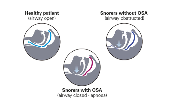 Three diagrams showing what happens to the upper airway when people snore or have sleep apnoea